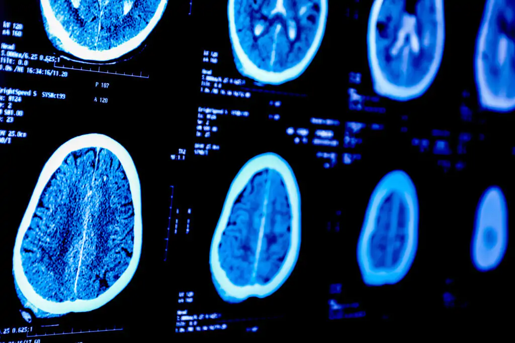 Le diagnostic de la maladie d’Alzheimer en 3 étapes clés | Alzheimer ...