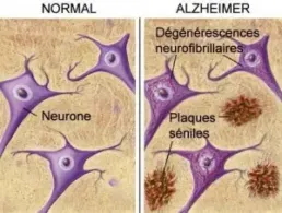 Les lésions de la maladie d’Alzheimer © Agence France Presse