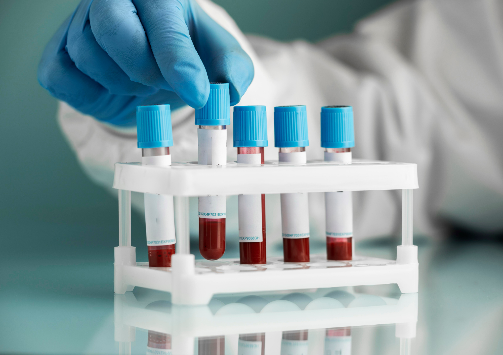 Un test sanguin pour aider au diagnostic de la maladie d’Alzheimer est ...